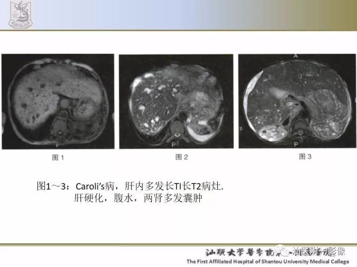影像PPT - 【PPT】先天性胆总管囊肿影像学诊断-25