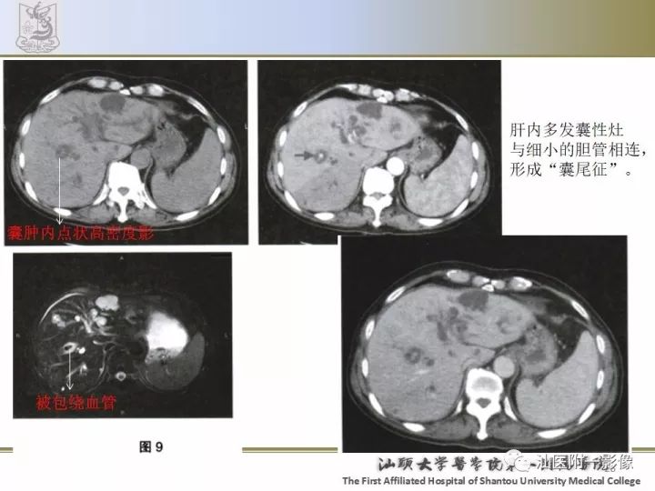 影像PPT - 【PPT】先天性胆总管囊肿影像学诊断-26
