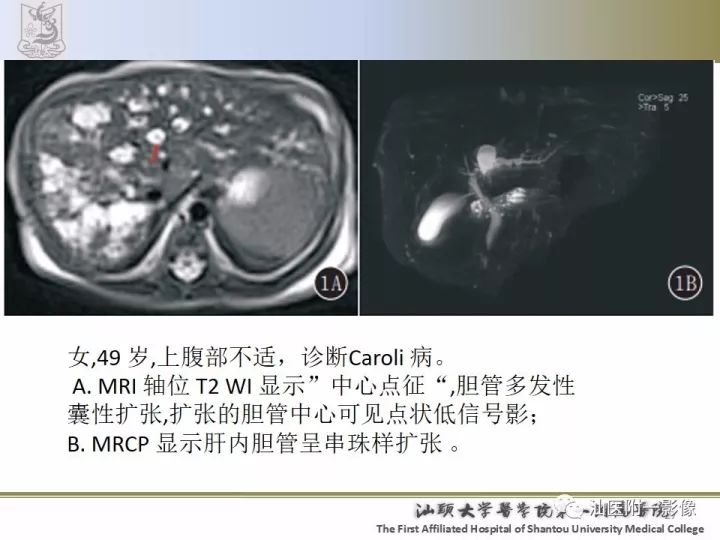 影像PPT - 【PPT】先天性胆总管囊肿影像学诊断-27