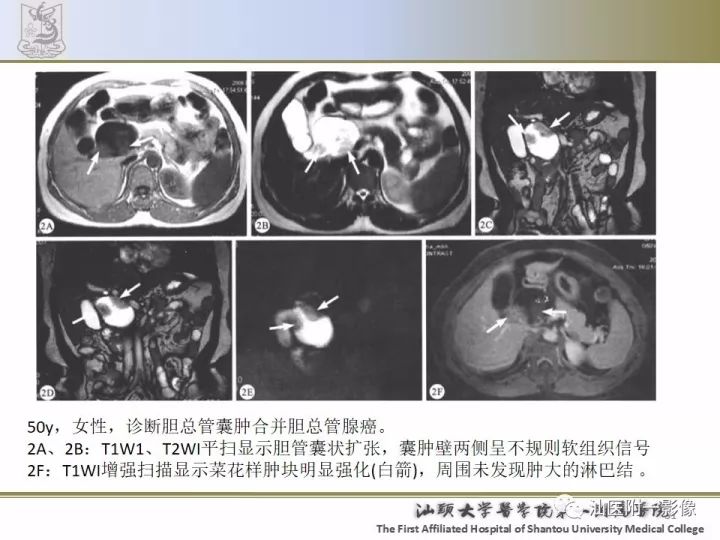 影像PPT - 【PPT】先天性胆总管囊肿影像学诊断-31