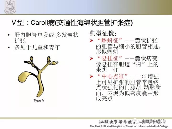 影像PPT - 【PPT】先天性胆总管囊肿影像学诊断-23
