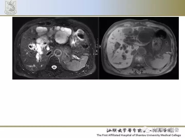 影像PPT - 【PPT】先天性胆总管囊肿影像学诊断-28
