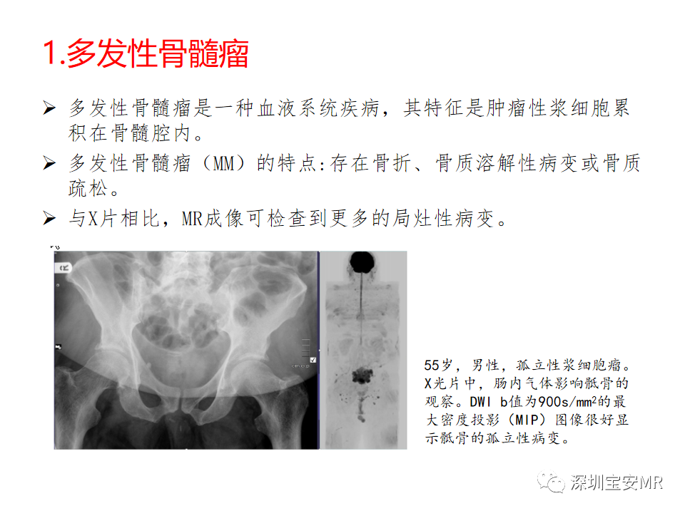影像PPT - 【PPT】肿瘤的全身磁共振成像：应用及适应症-3