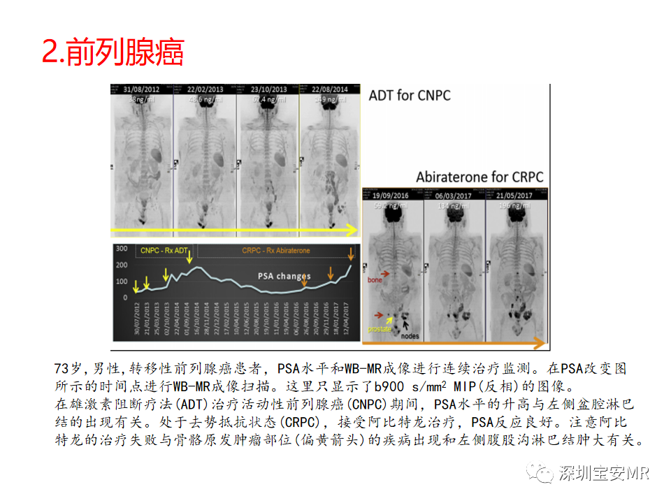 影像PPT - 【PPT】肿瘤的全身磁共振成像：应用及适应症-7