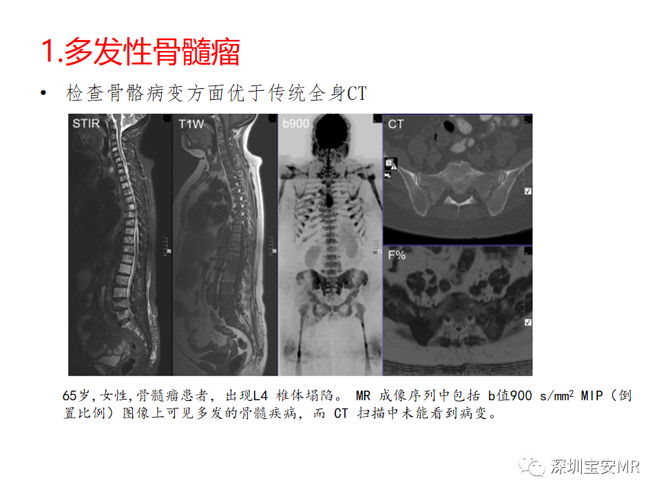 影像PPT - 【PPT】肿瘤的全身磁共振成像：应用及适应症-4