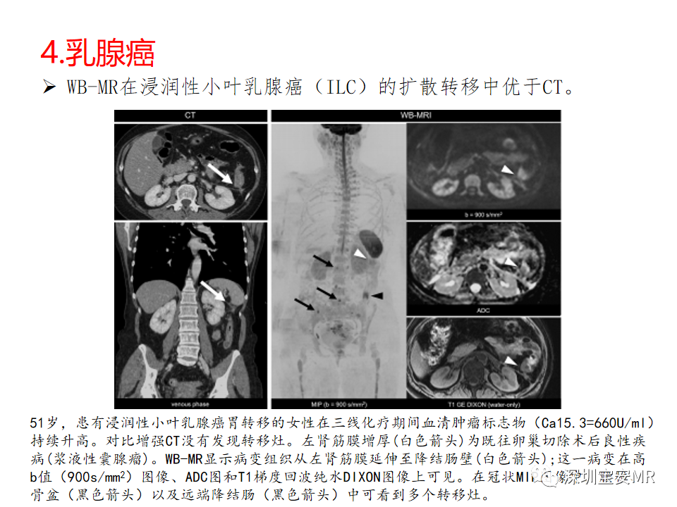 影像PPT - 【PPT】肿瘤的全身磁共振成像：应用及适应症-14