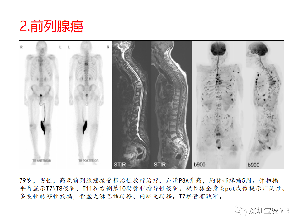 影像PPT - 【PPT】肿瘤的全身磁共振成像：应用及适应症-6