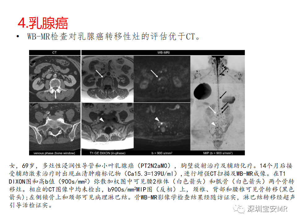 影像PPT - 【PPT】肿瘤的全身磁共振成像：应用及适应症-12