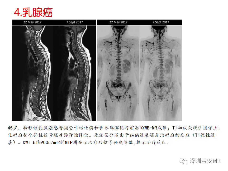 影像PPT - 【PPT】肿瘤的全身磁共振成像：应用及适应症-11