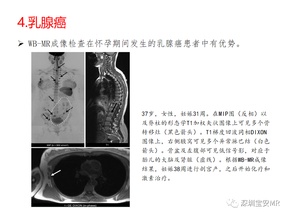 影像PPT - 【PPT】肿瘤的全身磁共振成像：应用及适应症-13