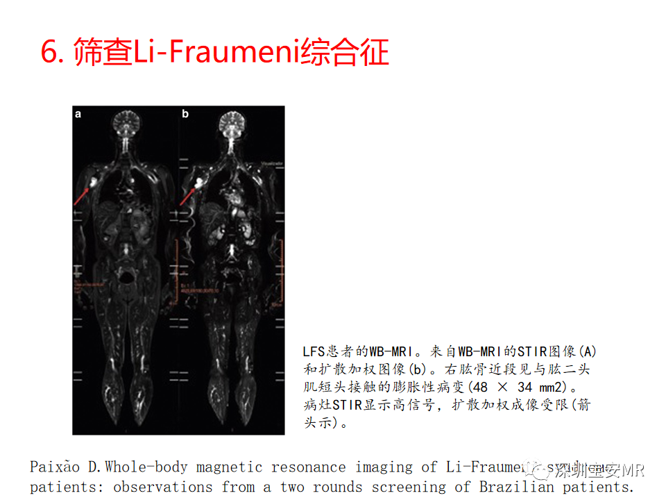 影像PPT - 【PPT】肿瘤的全身磁共振成像：应用及适应症-19