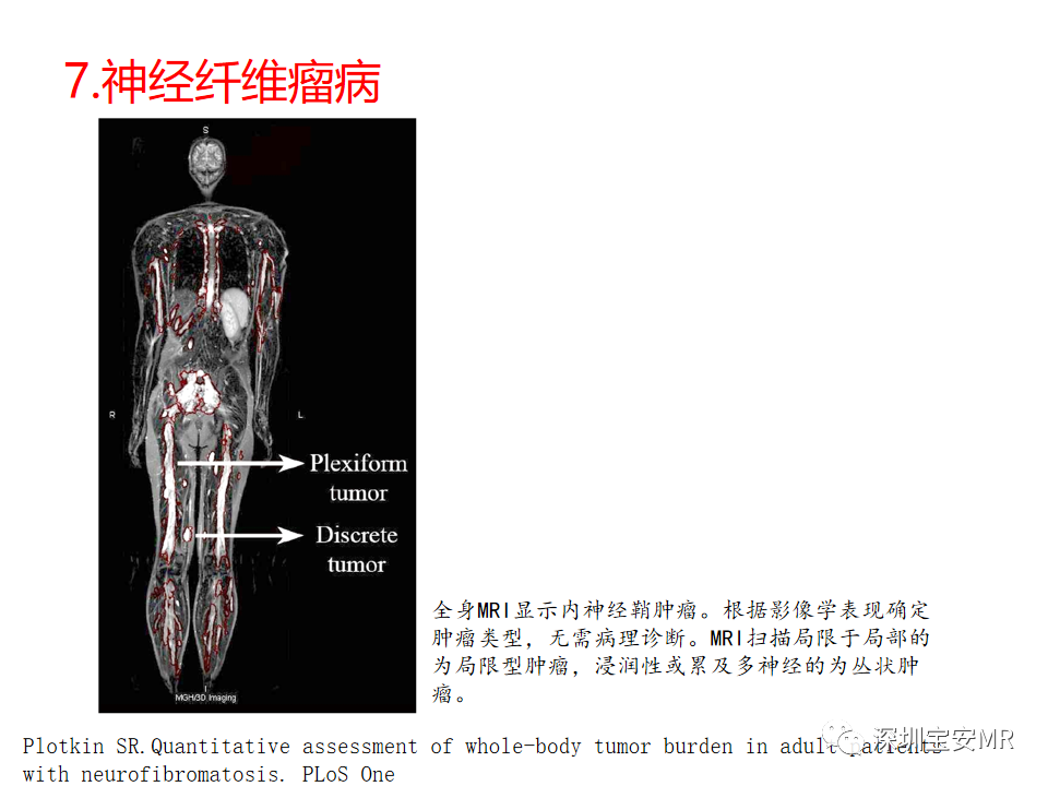 影像PPT - 【PPT】肿瘤的全身磁共振成像：应用及适应症-22