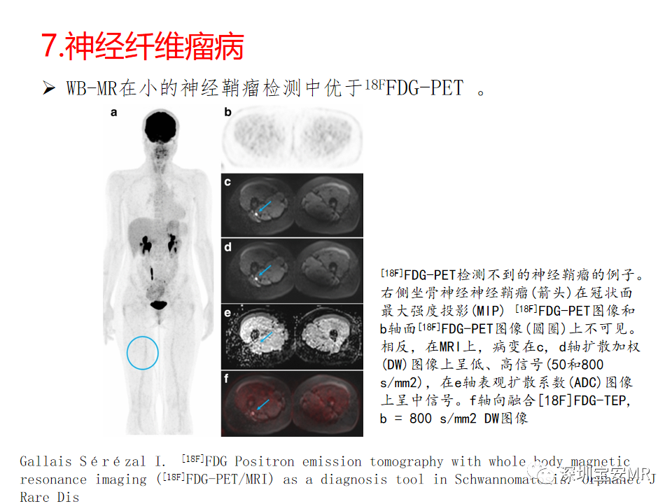 影像PPT - 【PPT】肿瘤的全身磁共振成像：应用及适应症-21