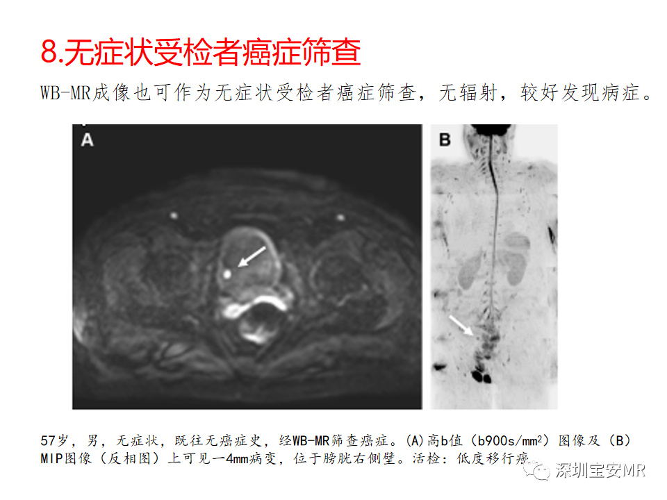 影像PPT - 【PPT】肿瘤的全身磁共振成像：应用及适应症-23