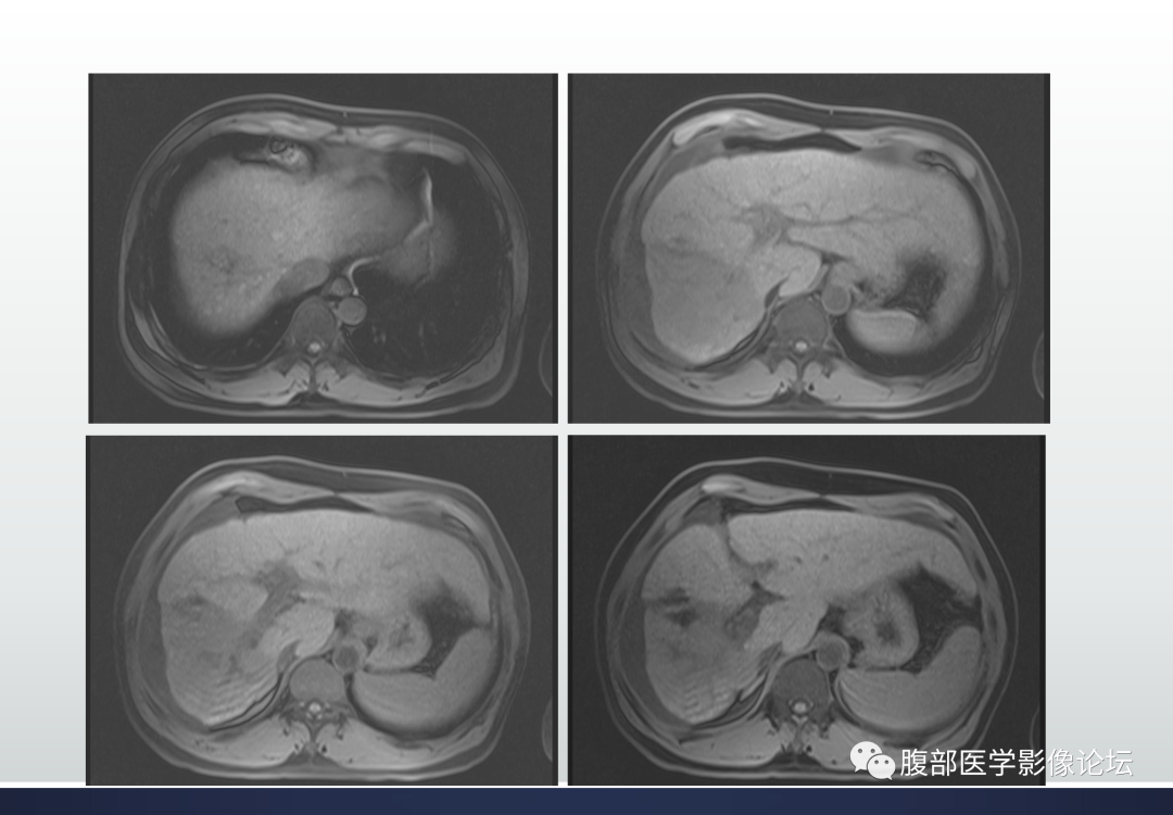 影像PPT - 【病例】肝脏胆管细胞癌1例MR影像-4