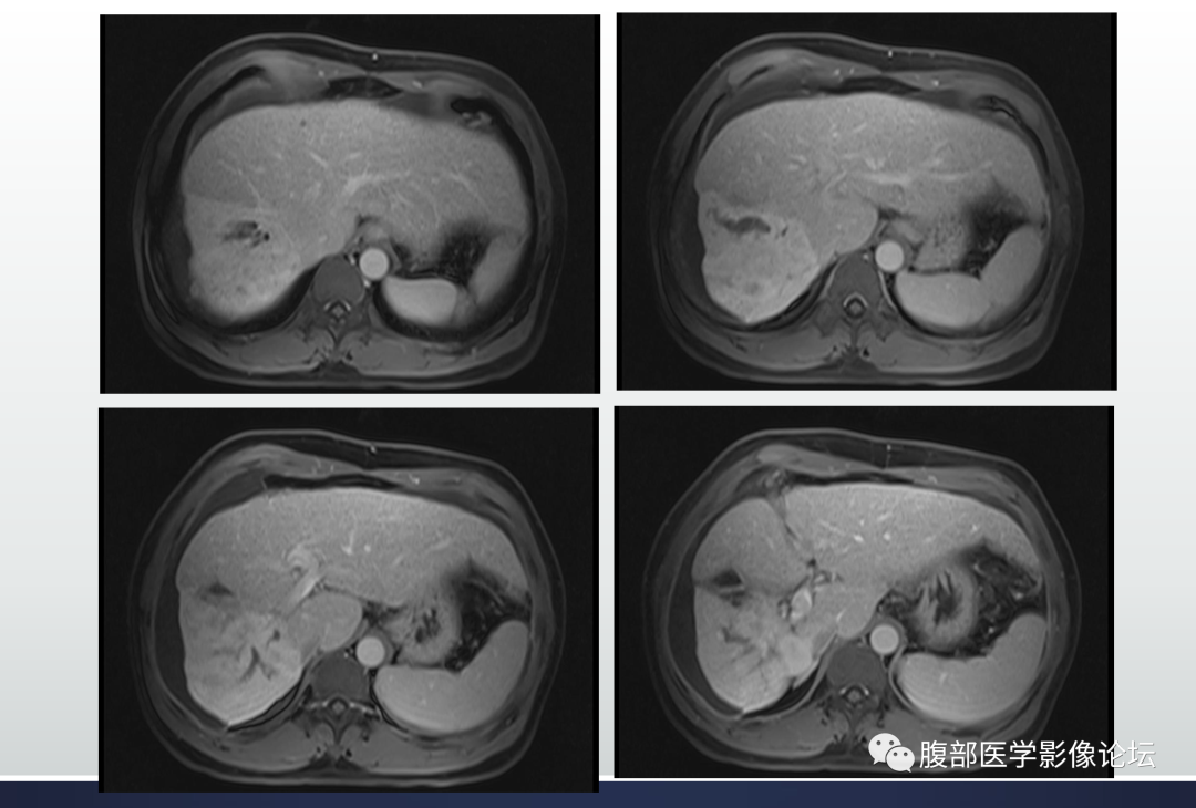 影像PPT - 【病例】肝脏胆管细胞癌1例MR影像-7