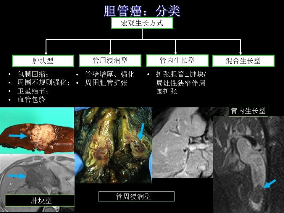 影像PPT - 【PPT】胆管癌（2019年）:最新的病理学、分类及影像学表现-6
