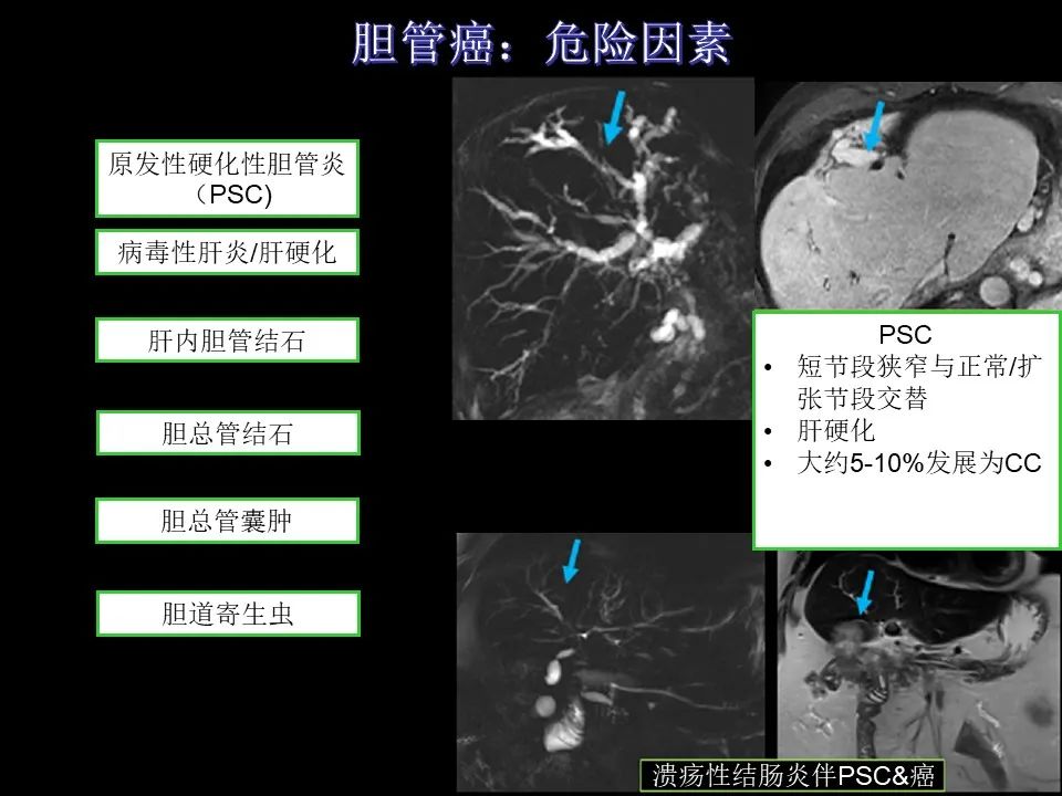 影像PPT - 【PPT】胆管癌（2019年）:最新的病理学、分类及影像学表现-9