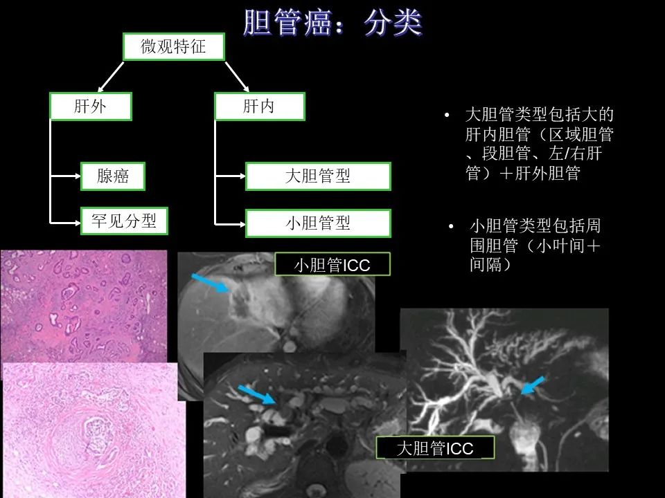 影像PPT - 【PPT】胆管癌（2019年）:最新的病理学、分类及影像学表现-7