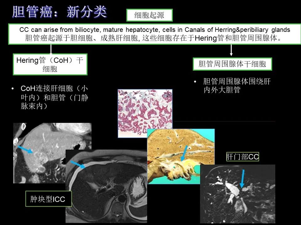 影像PPT - 【PPT】胆管癌（2019年）:最新的病理学、分类及影像学表现-8