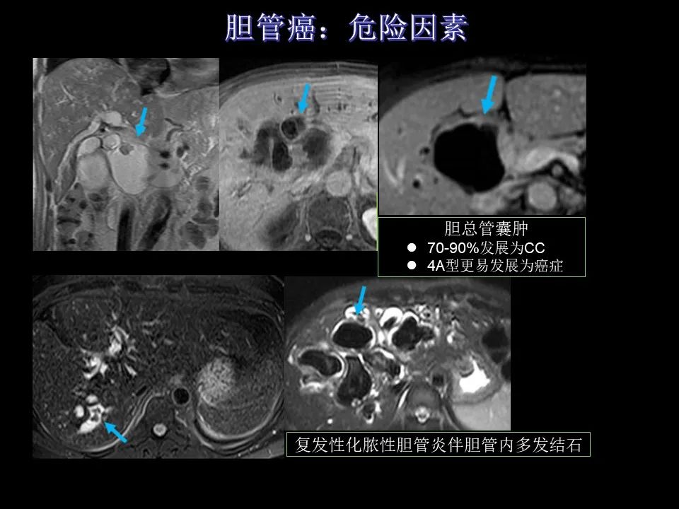 影像PPT - 【PPT】胆管癌（2019年）:最新的病理学、分类及影像学表现-10