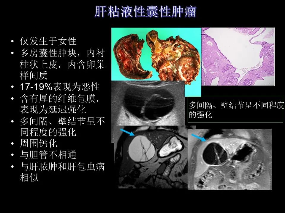 影像PPT - 【PPT】胆管癌（2019年）:最新的病理学、分类及影像学表现-13