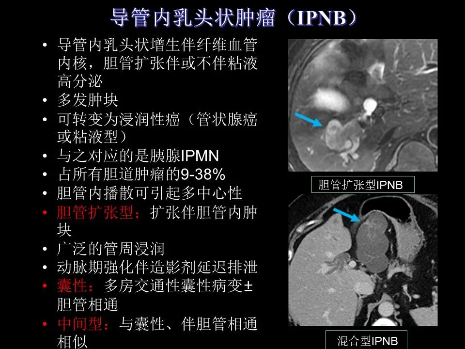 影像PPT - 【PPT】胆管癌（2019年）:最新的病理学、分类及影像学表现-15