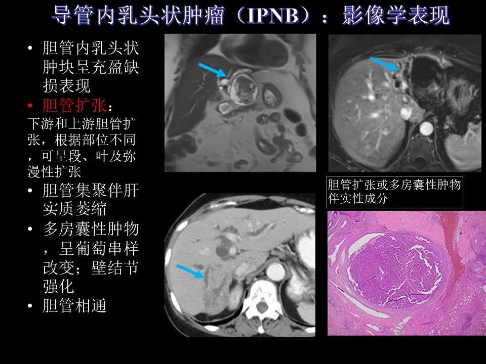 影像PPT - 【PPT】胆管癌（2019年）:最新的病理学、分类及影像学表现-16