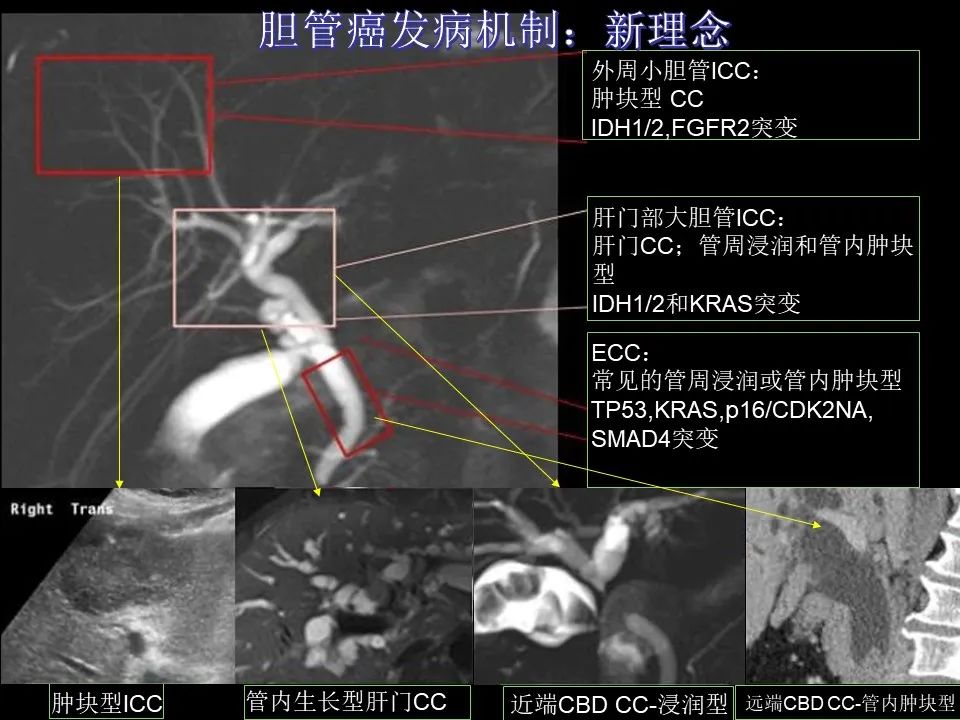影像PPT - 【PPT】胆管癌（2019年）:最新的病理学、分类及影像学表现-17