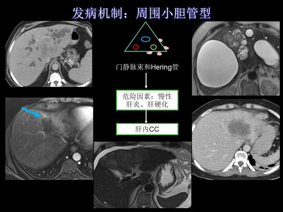 影像PPT - 【PPT】胆管癌（2019年）:最新的病理学、分类及影像学表现-18