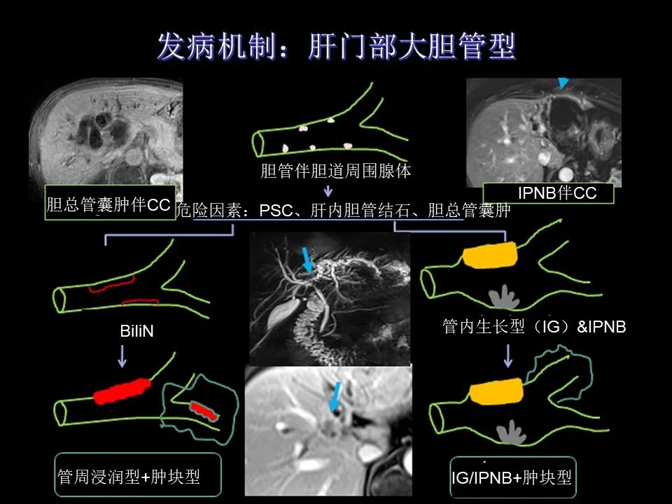 影像PPT - 【PPT】胆管癌（2019年）:最新的病理学、分类及影像学表现-19