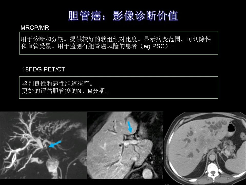 影像PPT - 【PPT】胆管癌（2019年）:最新的病理学、分类及影像学表现-21