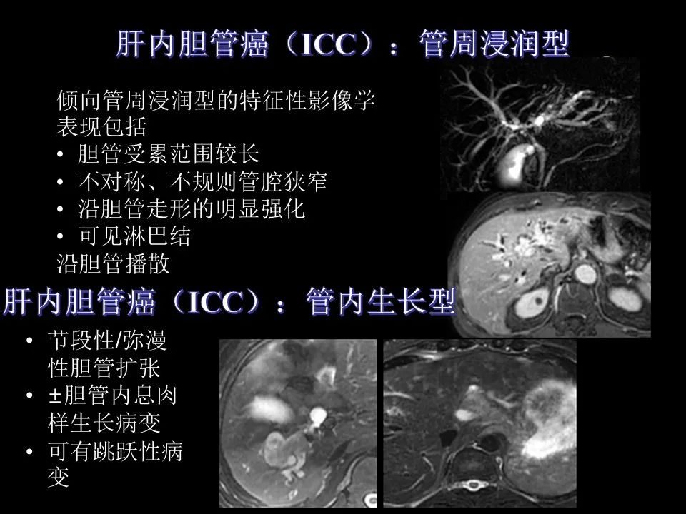 影像PPT - 【PPT】胆管癌（2019年）:最新的病理学、分类及影像学表现-23