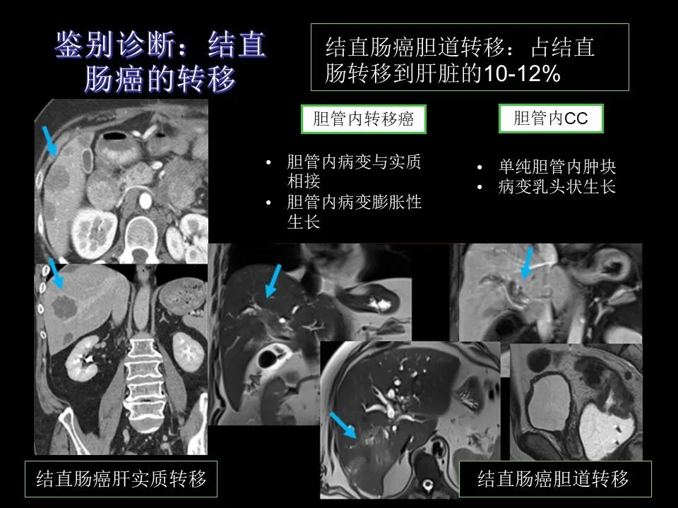 影像PPT - 【PPT】胆管癌（2019年）:最新的病理学、分类及影像学表现-25