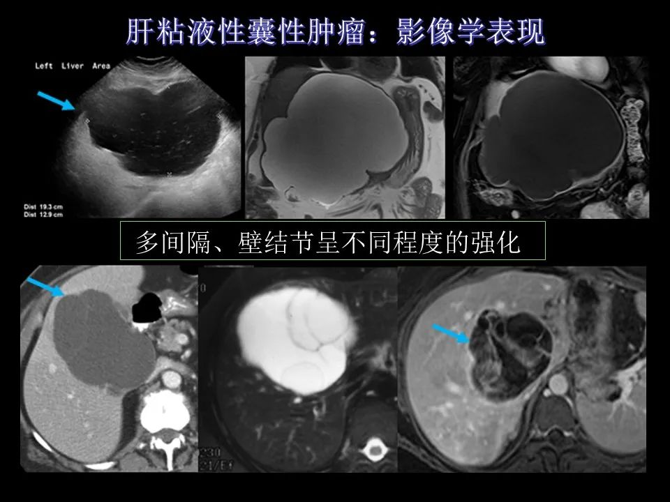 影像PPT - 【PPT】胆管癌（2019年）:最新的病理学、分类及影像学表现-14