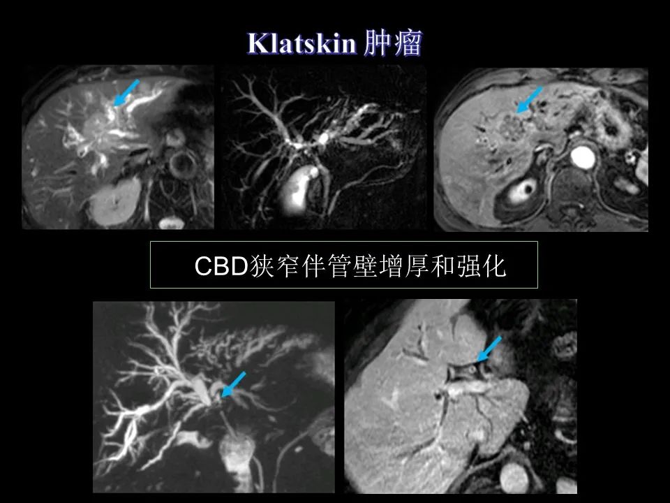影像PPT - 【PPT】胆管癌（2019年）:最新的病理学、分类及影像学表现-27