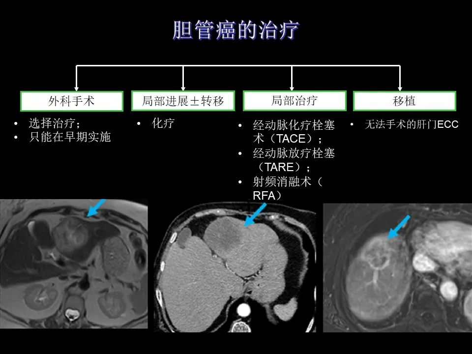 影像PPT - 【PPT】胆管癌（2019年）:最新的病理学、分类及影像学表现-28