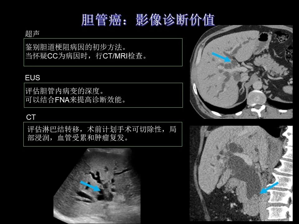 影像PPT - 【PPT】胆管癌（2019年）:最新的病理学、分类及影像学表现-20