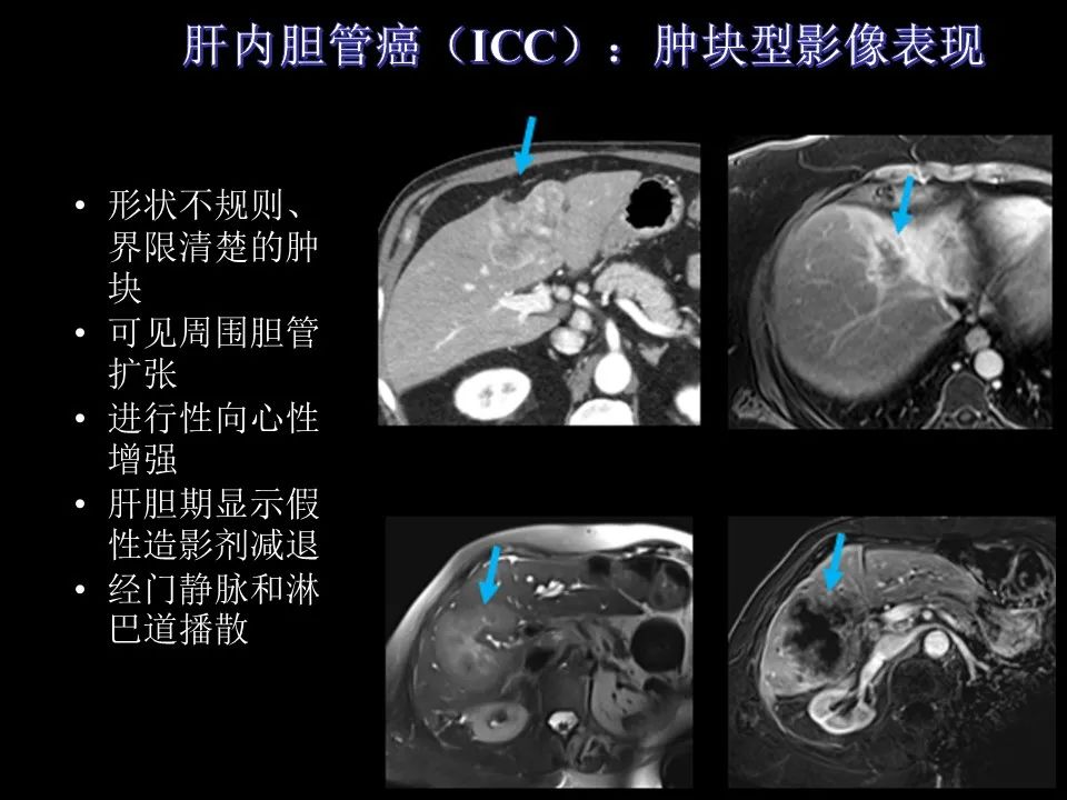 影像PPT - 【PPT】胆管癌（2019年）:最新的病理学、分类及影像学表现-22