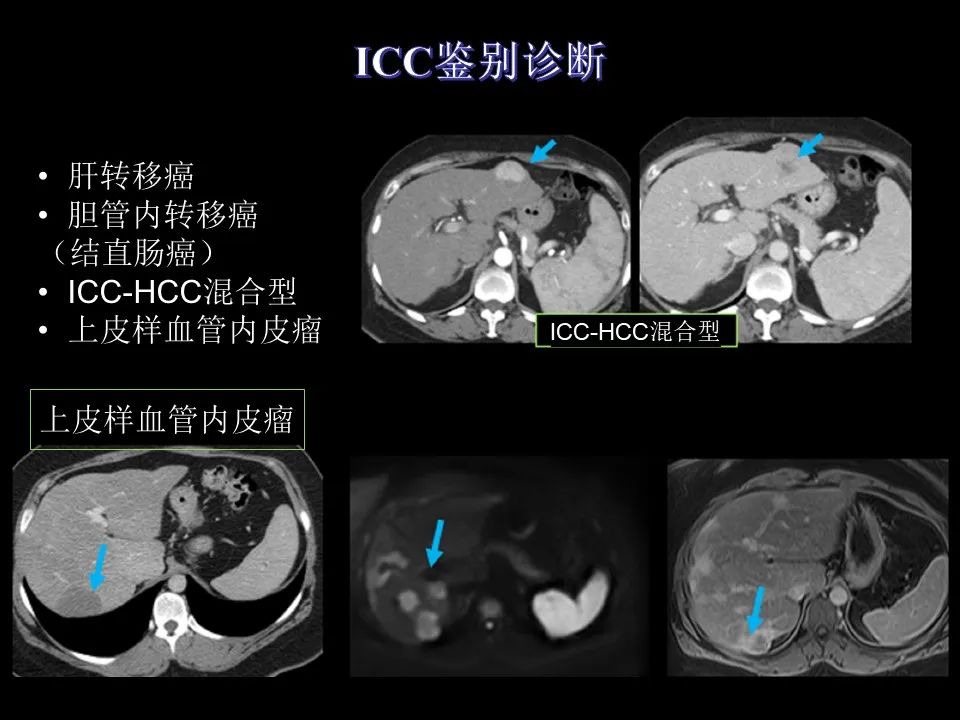 影像PPT - 【PPT】胆管癌（2019年）:最新的病理学、分类及影像学表现-24