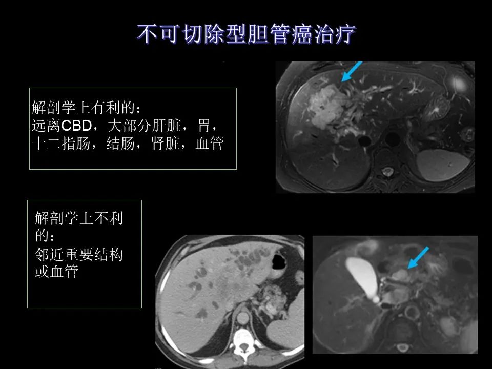 影像PPT - 【PPT】胆管癌（2019年）:最新的病理学、分类及影像学表现-31