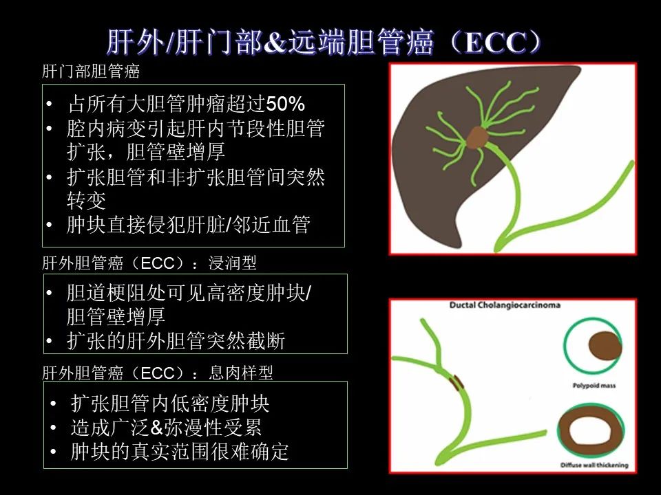 影像PPT - 【PPT】胆管癌（2019年）:最新的病理学、分类及影像学表现-26