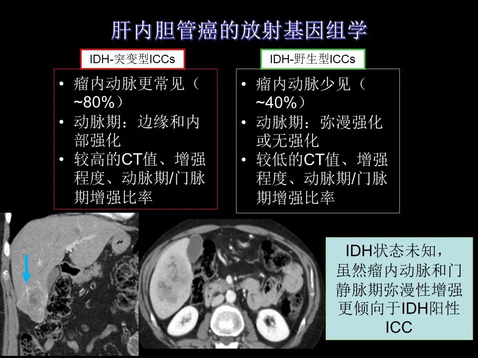 影像PPT - 【PPT】胆管癌（2019年）:最新的病理学、分类及影像学表现-32
