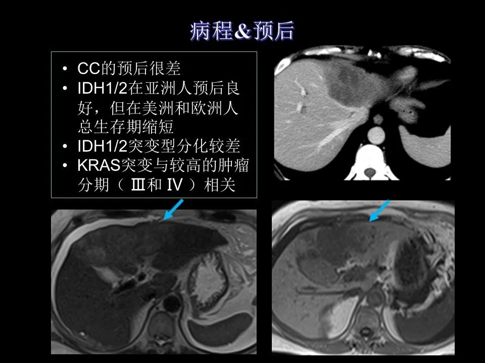 影像PPT - 【PPT】胆管癌（2019年）:最新的病理学、分类及影像学表现-34