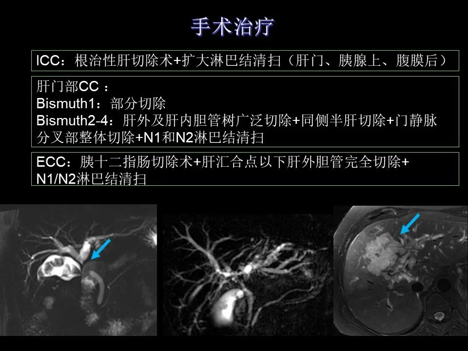 影像PPT - 【PPT】胆管癌（2019年）:最新的病理学、分类及影像学表现-29