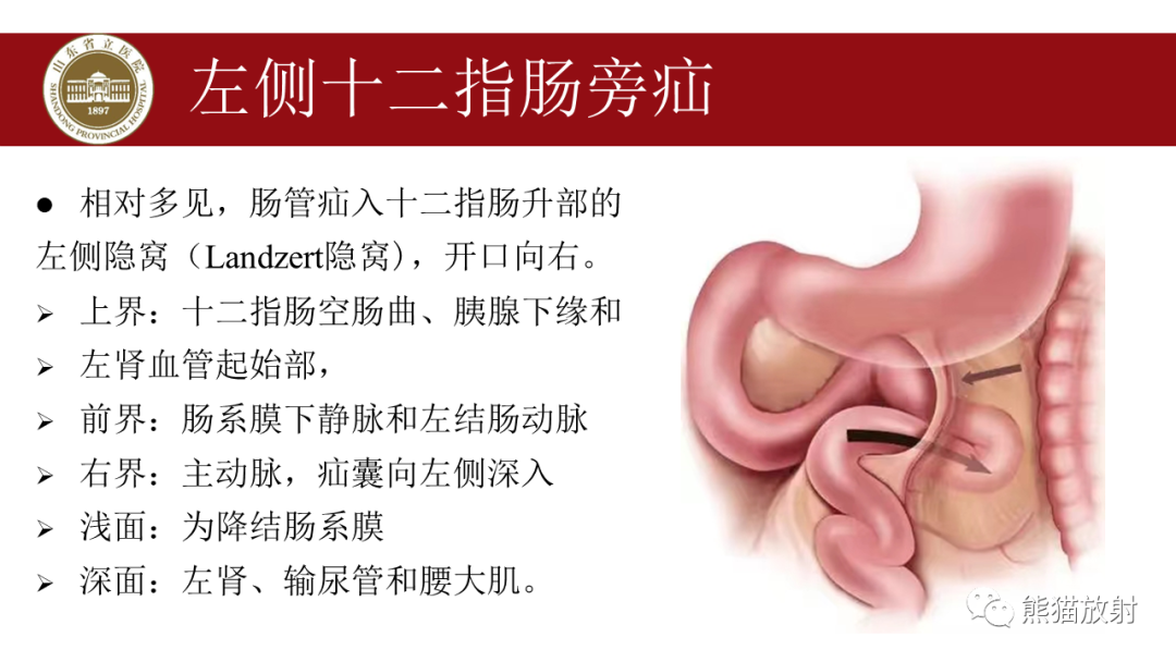 影像PPT - 【PPT】腹内疝影像表现-8