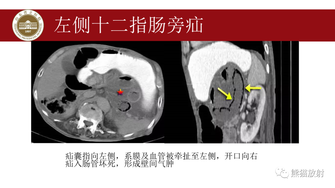 影像PPT - 【PPT】腹内疝影像表现-11