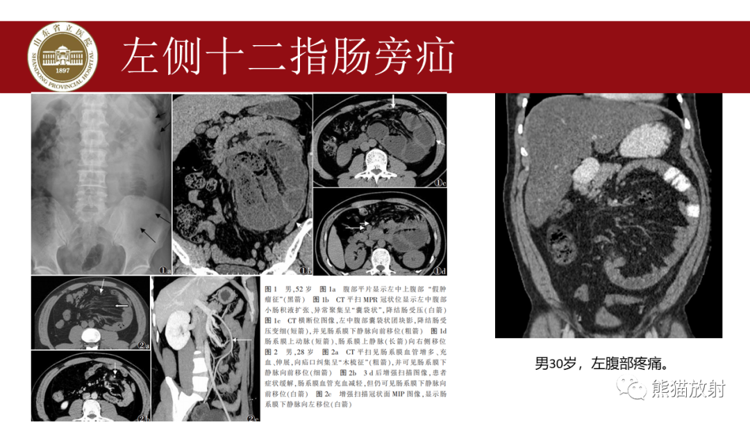 影像PPT - 【PPT】腹内疝影像表现-10