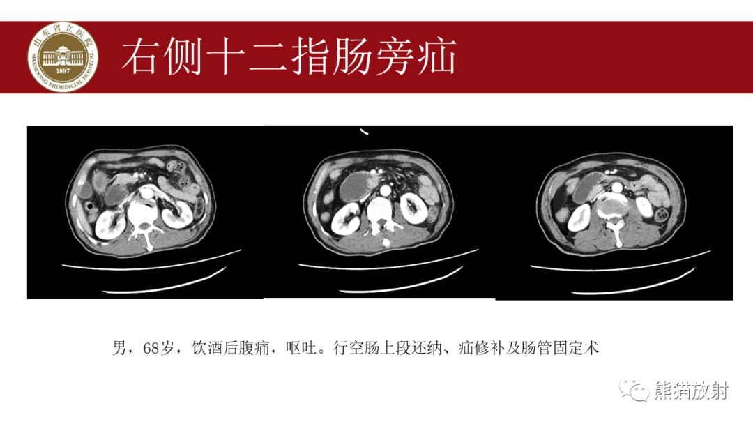 影像PPT - 【PPT】腹内疝影像表现-15