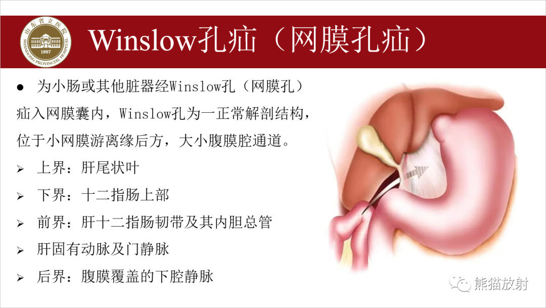 影像PPT - 【PPT】腹内疝影像表现-17